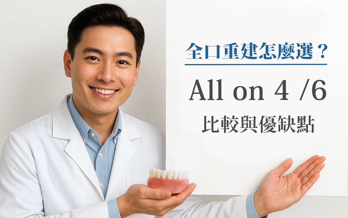 ALL-ON-4 與 ALL-ON-6 全口重建植牙技術示意圖