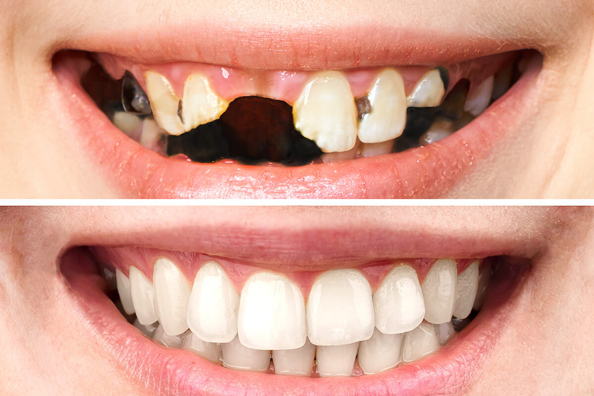 新莊開惠牙醫診所_全口重建_重新擁有正常的咀嚼功能 有助於於促進身心的健康