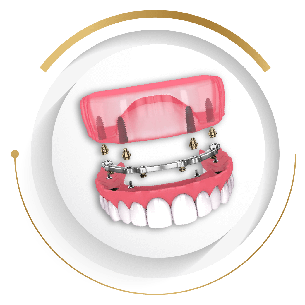 新莊開惠牙醫診所_全口重建_All-on(4~6)全口植牙